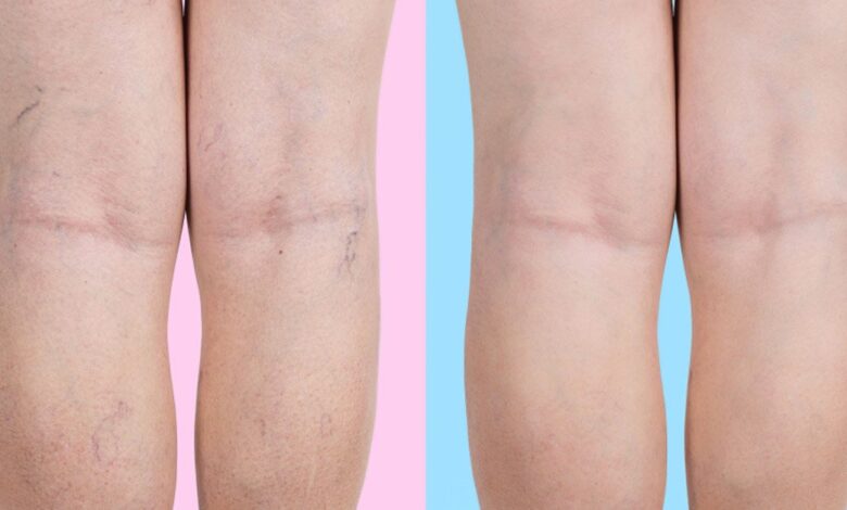 varices