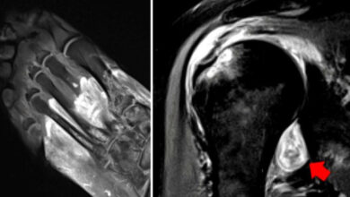 Revela nuevo estudio que el Covid-19 puede causar gangrena, provocando que el cuerpo se ataque a sí mismo