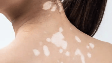 vitiligo